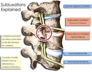 What Is A Subluxation And What Does It Do To Me?